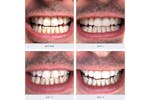 Spotlight Professional LED Teeth Whitening System | LEDSYSTEM Spotlight Professional LED Teeth Whitening System | LEDSYSTEM